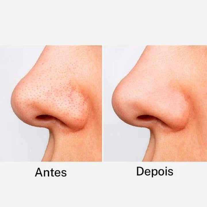 Removedor de Cravos Lanbena + 60 Adesivos Aplicadores (Brinde) Pague 1 leve 2