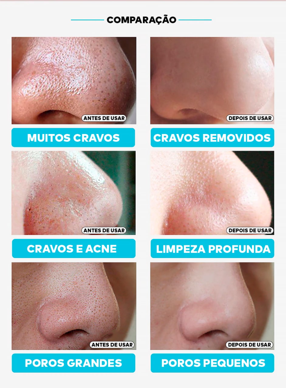 Removedor de Cravos Lanbena + 60 Adesivos Aplicadores (Brinde) Pague 1 leve 2