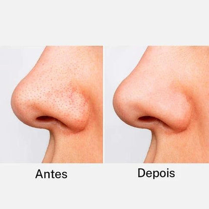 Removedor de Cravos Lanbena + 60 Adesivos Aplicadores (Brinde) Pague 1 leve 2
